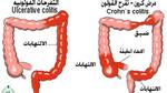 كيفية علاج مرض كرون