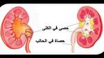 حصى الكلى أسبابها وعلاجها