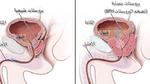 مرض البروستاتا