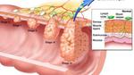 سرطان المستقيم وعلاجه