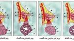مراحل تطور سرطان الثدي