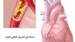 اعراض مرض القلب