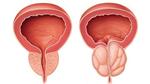 الفرق بين تضخم البروستاتا الحميد والخبيث