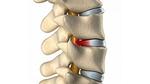 علاج غضروف الظهر