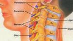 علاج غضروف الرقبة