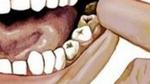 علاج ألم ضرس العقل