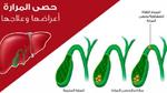 ما أسباب تكون حصوة المرارة