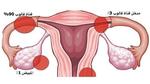 ما هي أعراض انسداد قناة فالوب