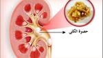 ما هي أعراض رمل الكلى