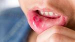 ما هي أنواع قرحة الفم