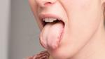 ما هو سبب تشقق اللسان