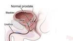 ما هي البروستاتا وما وظيفتها