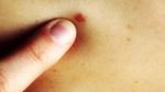 ما هو سبب ظهور نقط حمراء على الجلد