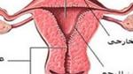 ما هو تليف الرحم