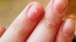 ظهور بقع بيضاء على الأظافر