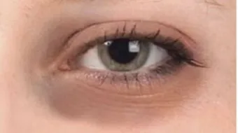 علاج للسواد تحت العين