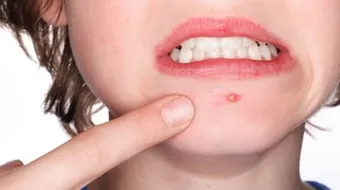 وصفة طبيعية لإزالة الحبوب من الوجه