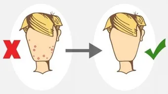طريقة سريعة لعلاج حب الشباب