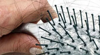 وصفة لتساقط الشعر