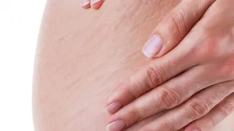 وصفة لإزالة تشققات الجسم