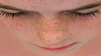 وصفة لإزالة النمش من الوجه نهائياً