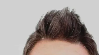 حل للقشرة في الشعر