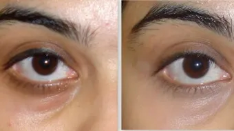 حل للهالات السوداء