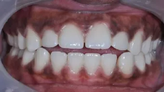 ملخص عن مرض أديسون