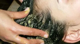 فوائد الآس للشعر