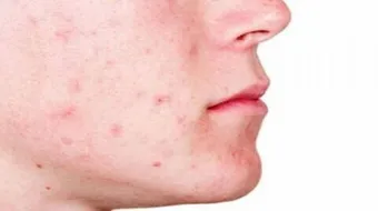 حب الشباب في المنام