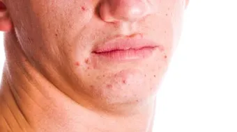 طريقة علاج حب الشباب