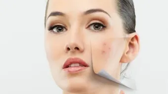 طرق معالجة حب الشباب