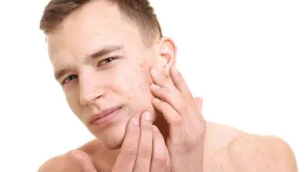 طرق علاج حب الشباب