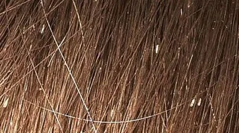 طريقة فعالة للتخلص من القمل