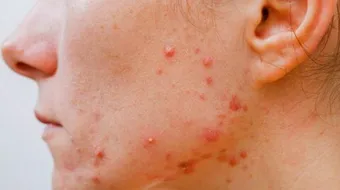 طريقة فعالة لعلاج حب الشباب