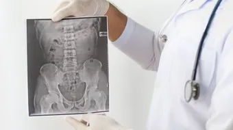 التهاب الفقار اللاصق