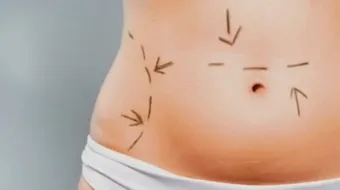 فوائد شفط البطن