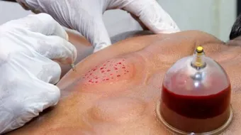 فوائد حجامة الأخدعين