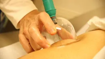 فوائد الحجامة في الوجه