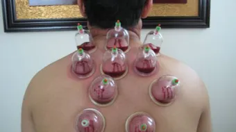 فوائد التداوي بالحجامة