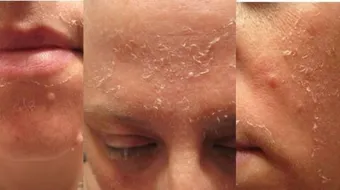 فوائد التقشير للبشرة