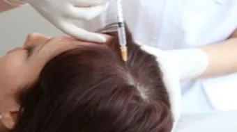 فوائد الميزوثيرابي للشعر