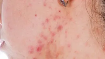 فوائد زبدة الشيا لحب الشباب