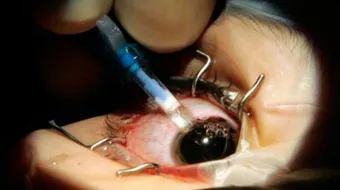 فوائد عملية الليزر للعيون