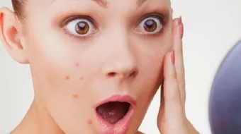 آثار حب الشباب السوداء