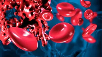 تخثر الدم - الجلطة الوريدية