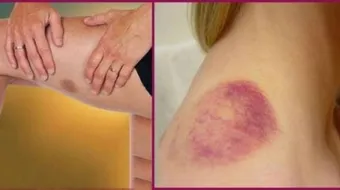 ظهور بقع زرقاء في الجسم