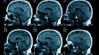 ضمور المخ عند الأطفال