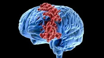 سرطان المخ وأعراضه