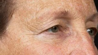 ظهور البقع البنية على الوجه